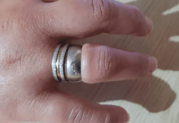  Susto de mujer por anillo que se le trabó en un dedo; bomberos la salvaron de amputación