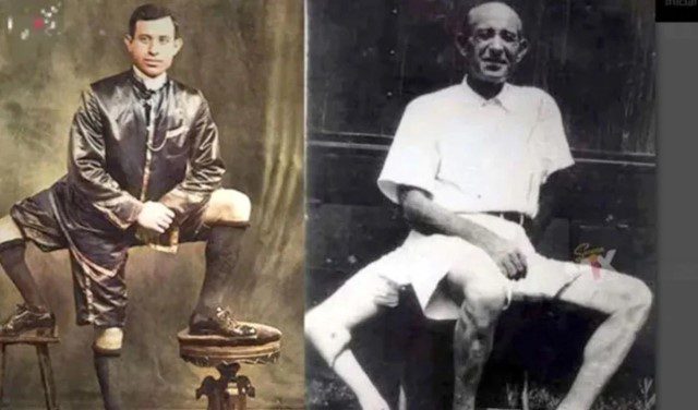  El inusual caso de Francesco Lentini, el hombre que tuvo dos penes y tres piernas